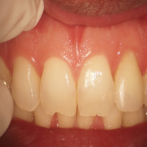 Can surgical extrusion be used for fractured teeth?