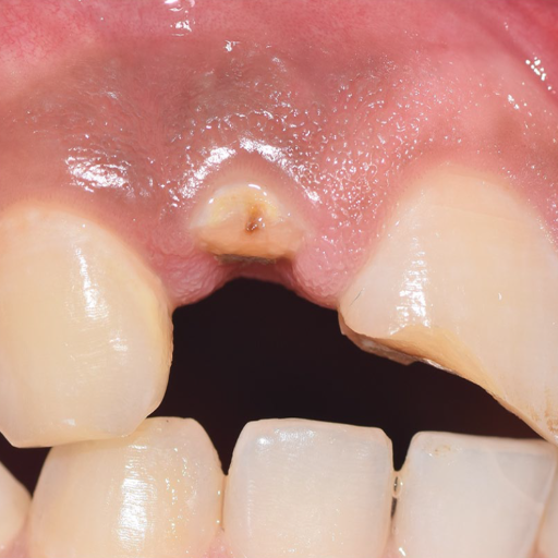 How is the surgical extrusion technique performed?