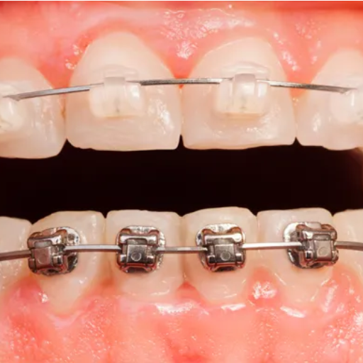 What are the benefits and risks of surgical extrusion?