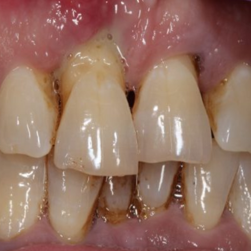 What is surgical extrusion in dentistry?